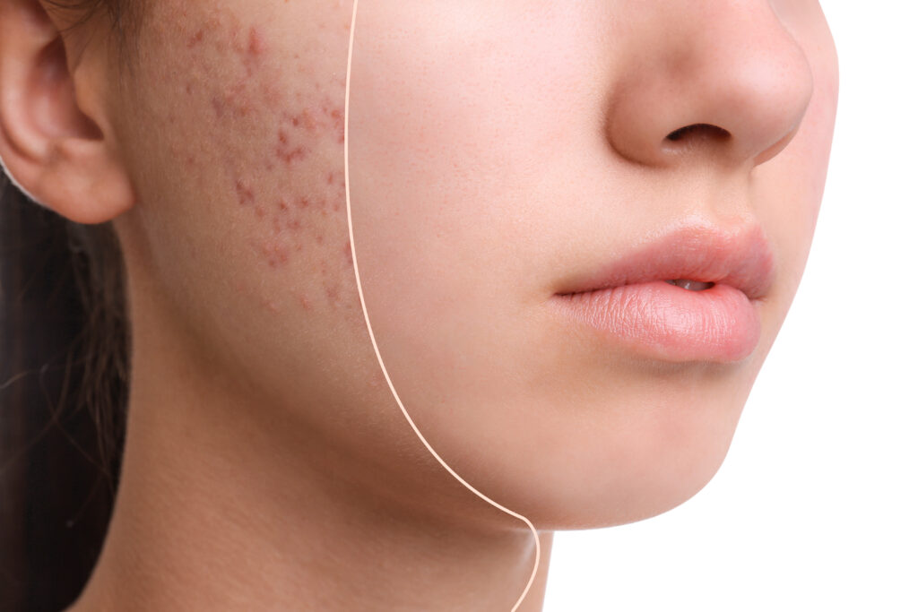 skin care and treatment for acne