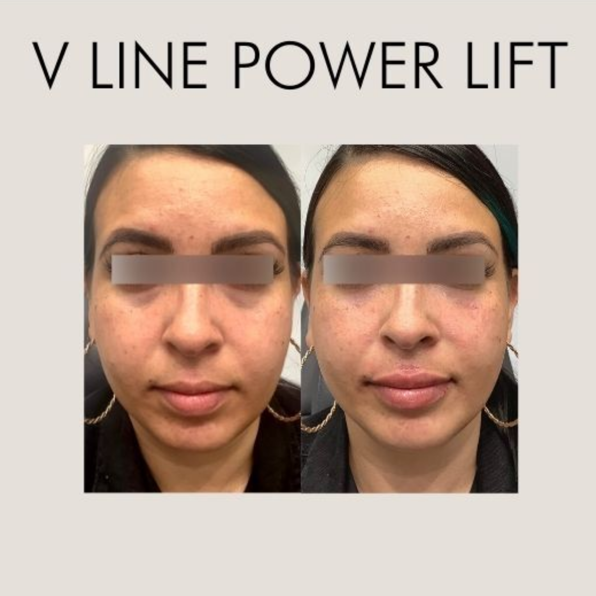 Skin Perfect Brothers - vline power lift beaf