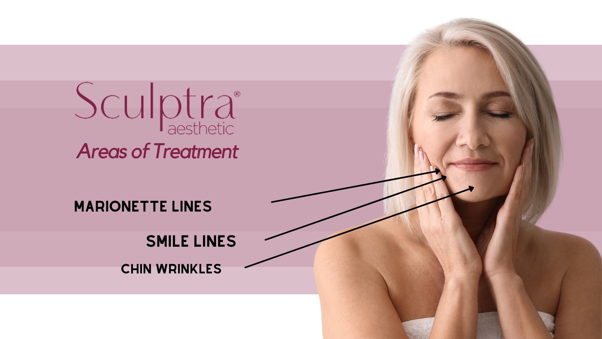 Skin Perfect Brothers Sculptra