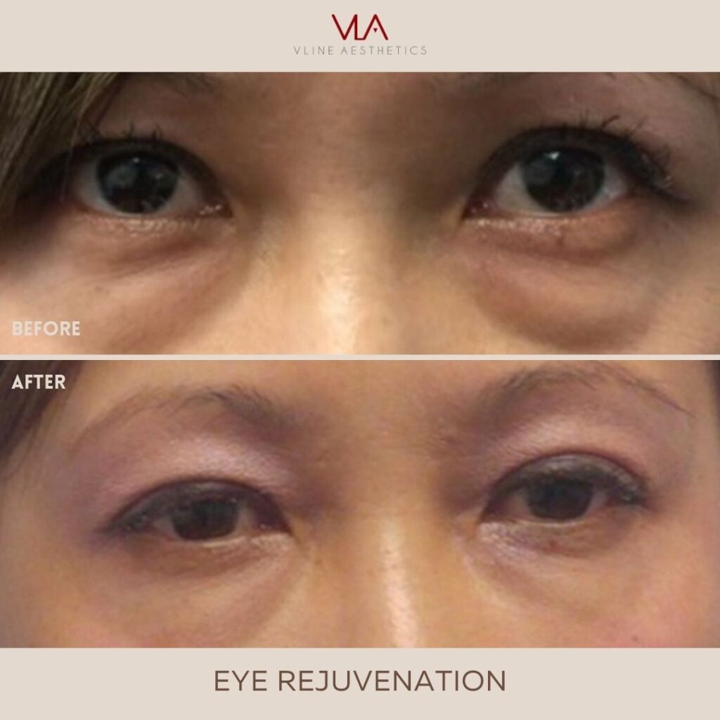 Skin Perfect Brothers Eye Rejuvenation - Revise (2)
