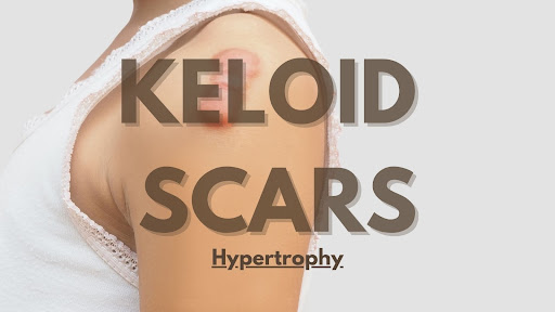 Keloid Scars Skin perfect brothers