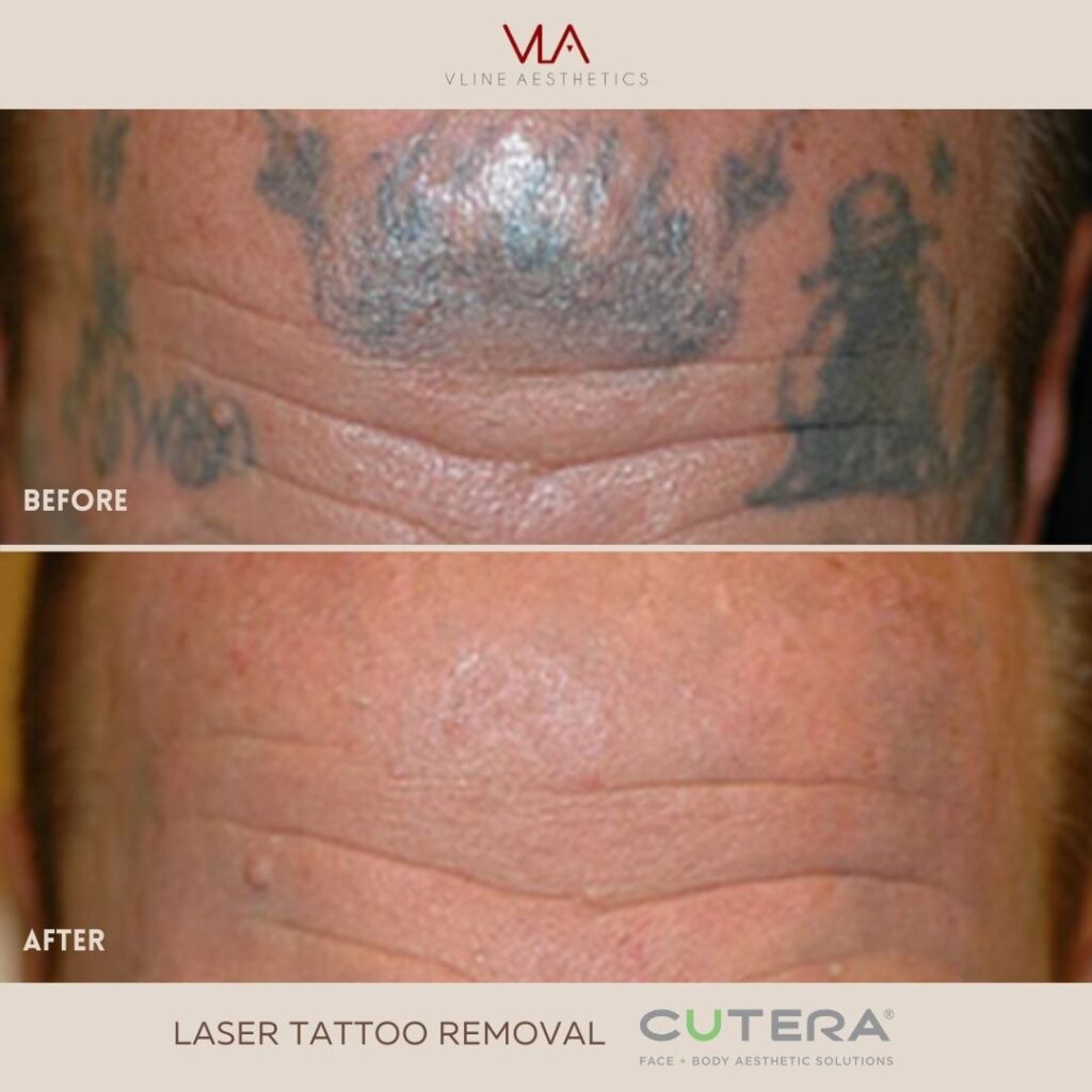 LTR - Forehead - Vendor Laser tattoo removal skin perfect brothers