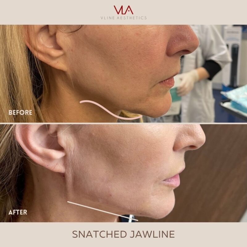 Jawline Lift V LINE AESTHETICS