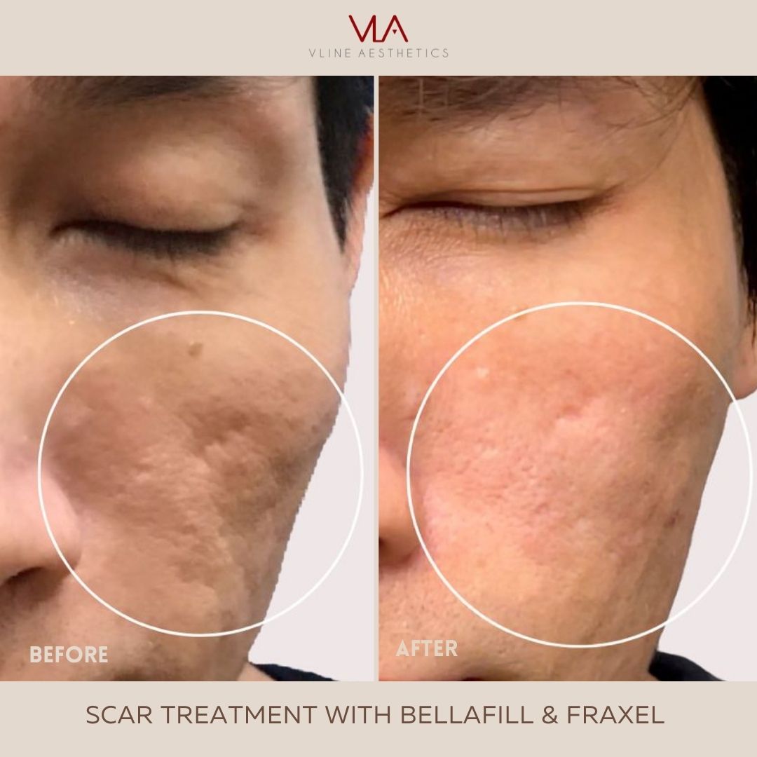 Scar Treatment with Bellafill and Fraxel (Man)