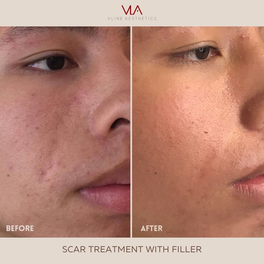 Scar treatment with Filler