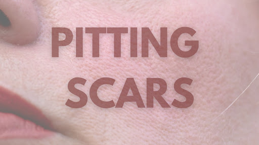 Skin perfect brothers pitting scars