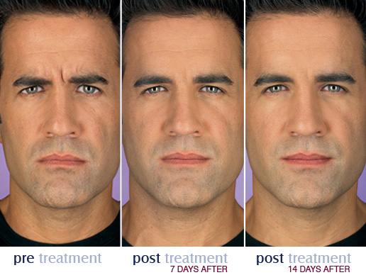 botox-for-men skin perfect brothers