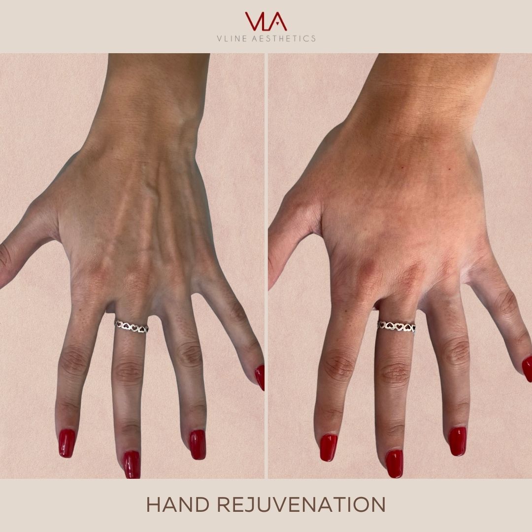 Skin Perfect brothers Hand Rejuvenation