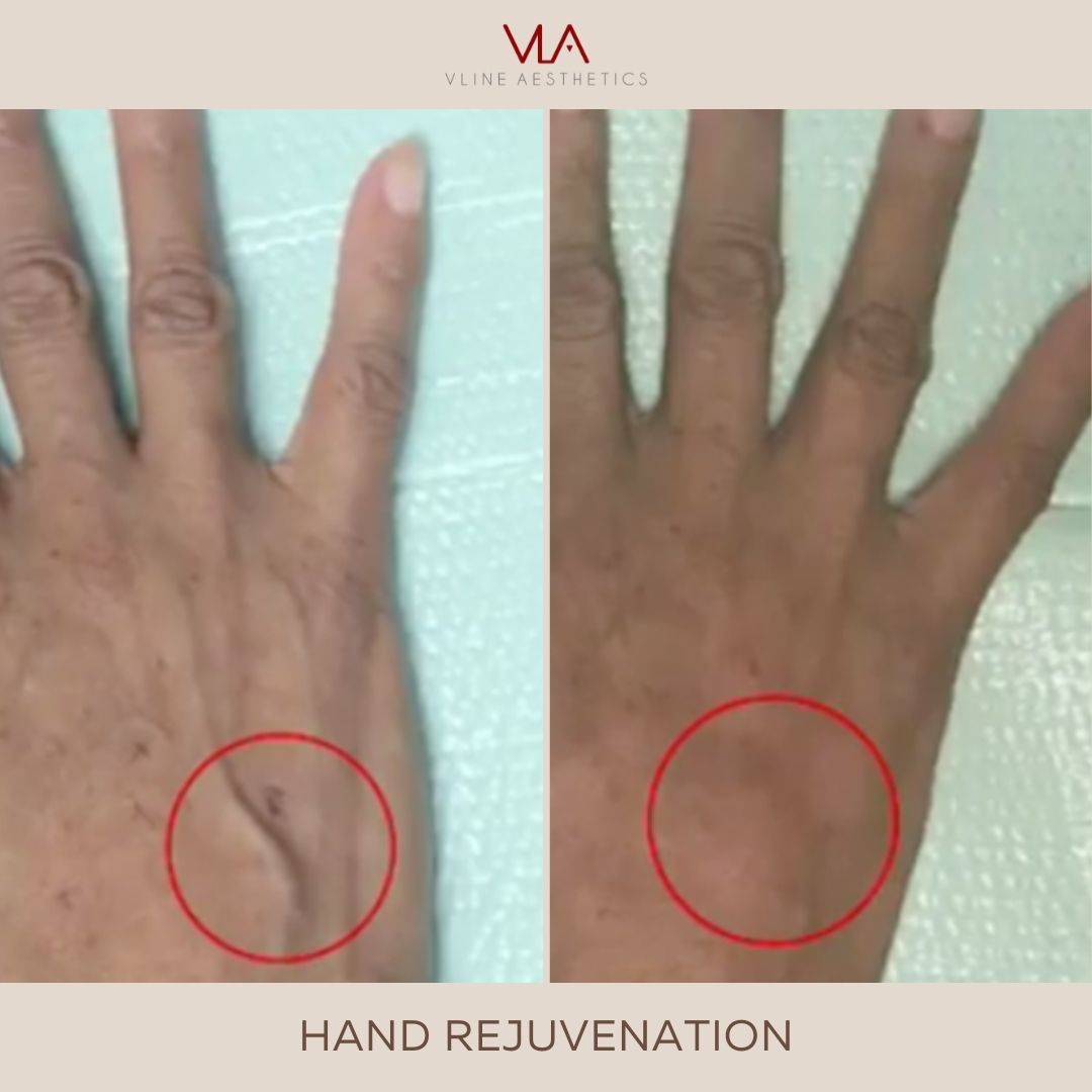 Skin Perfect brothers Hand Rejuvenation