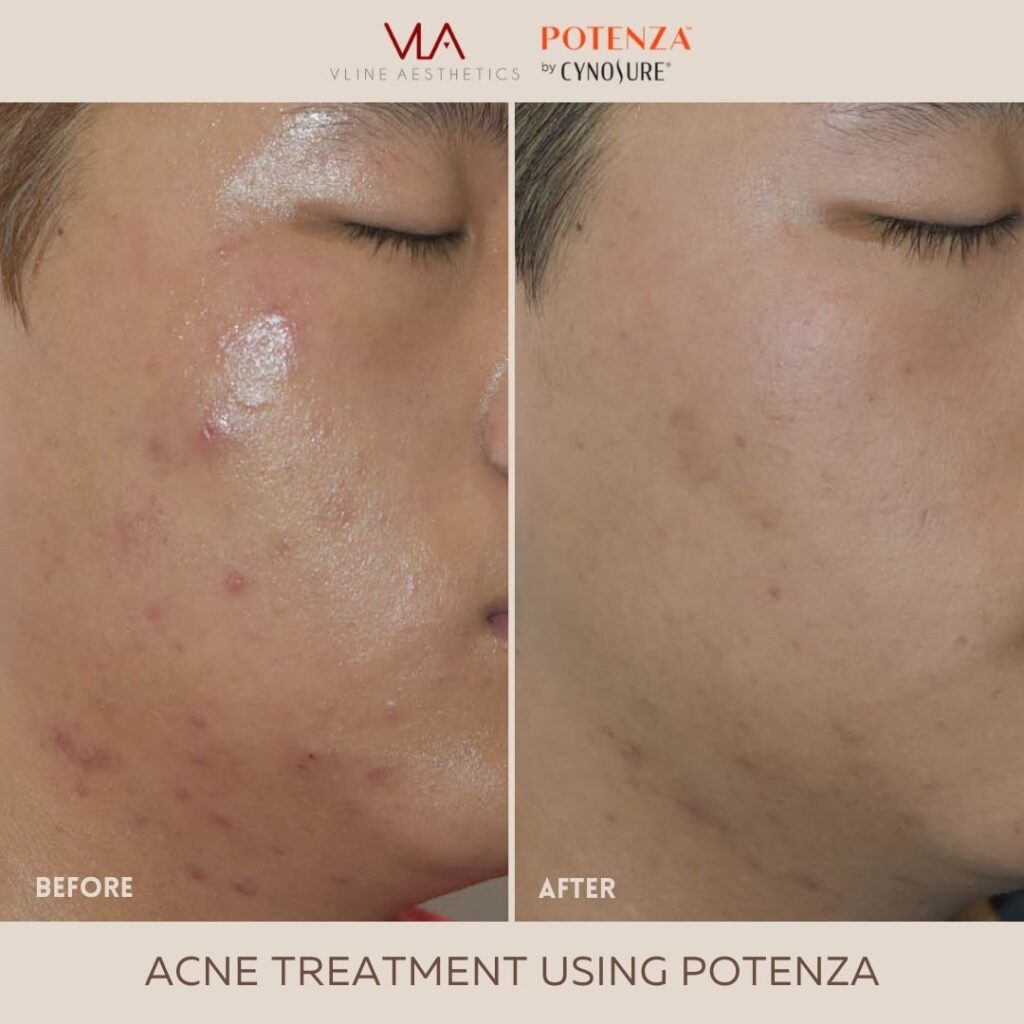 Skin Perfect Brothers Potenza (Skin Tightening Acne Treatment