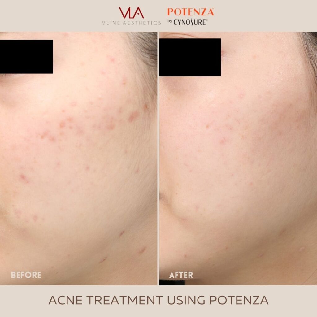 potenza acne treatment skin perfect brothers