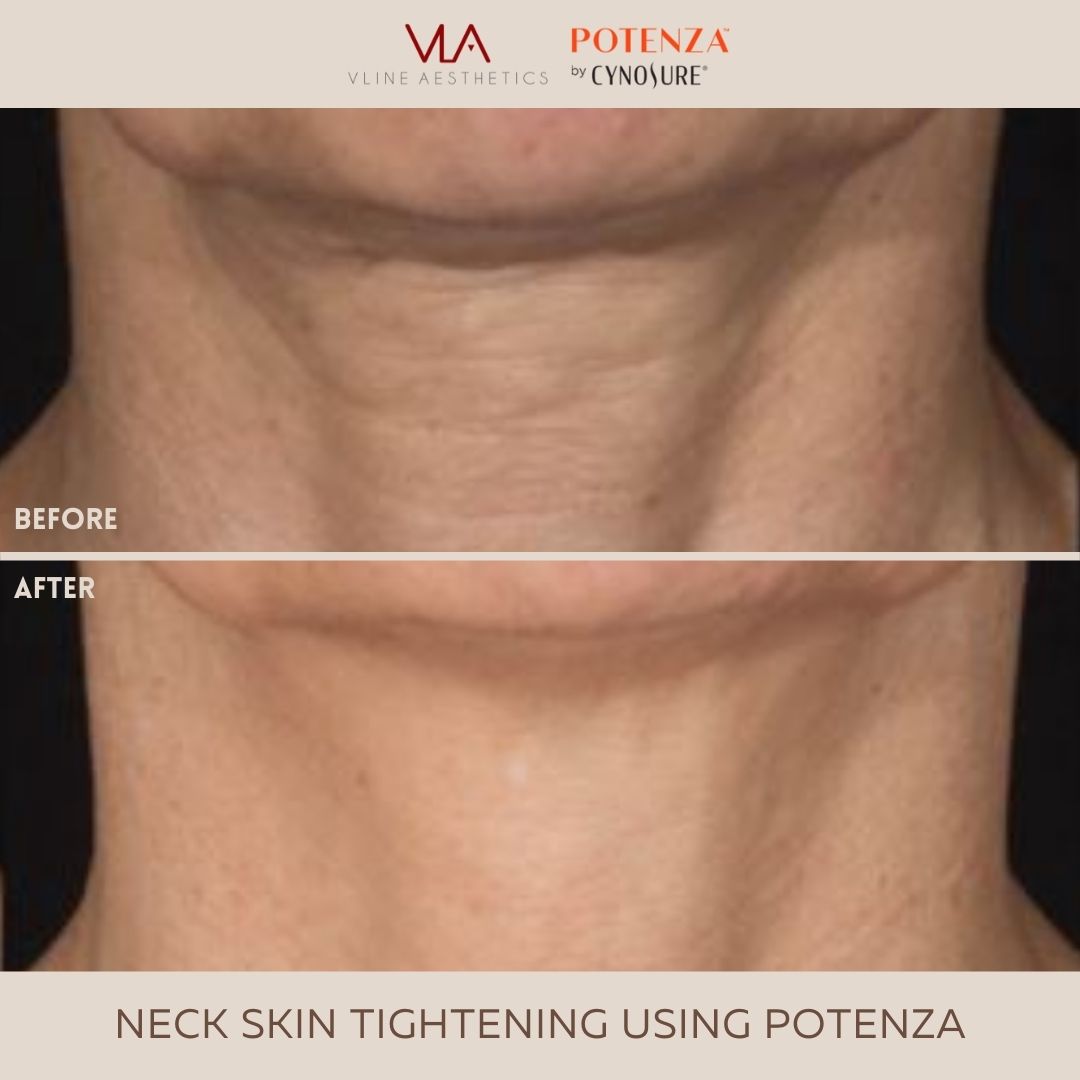 Skin Perfect Brothers Potenza (Neck Tightening)