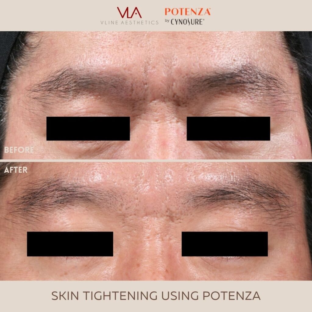 Skin Perfect Brothers Potenza (Skin Tightening Eye Rejuvenation) 2