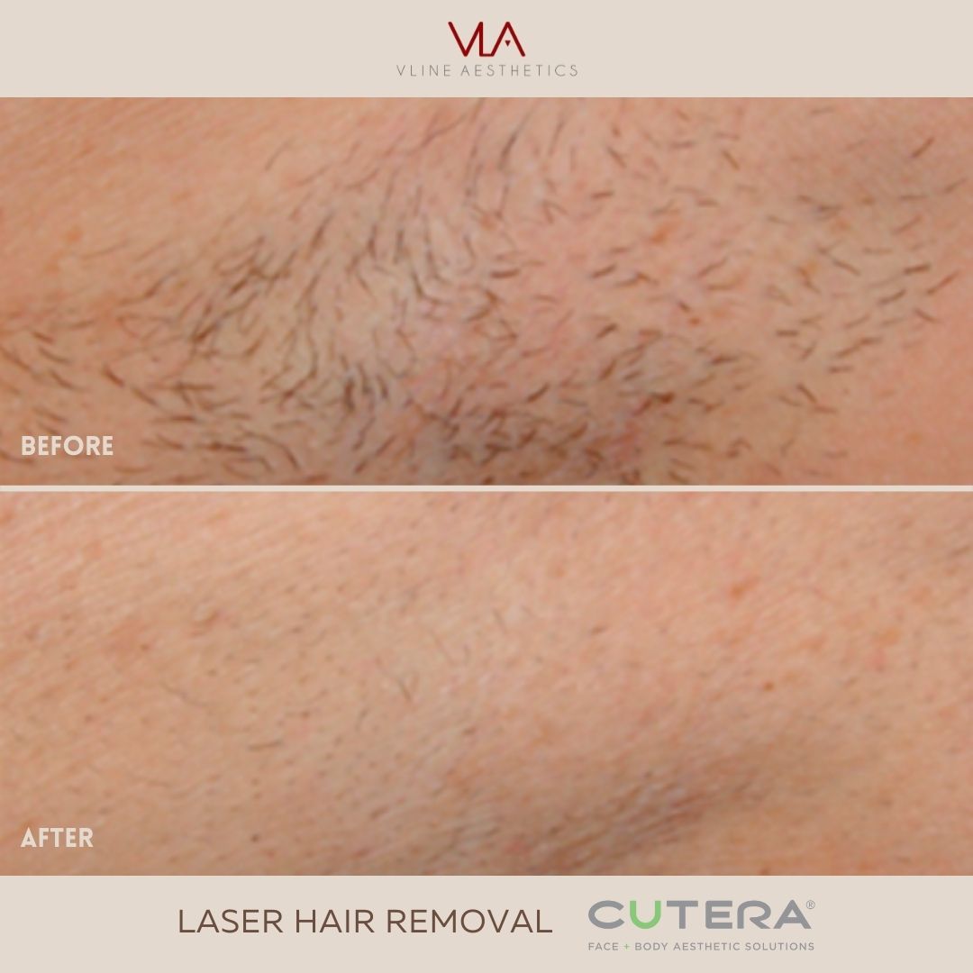 Skin Perfect Brothers Laser Hair Removal