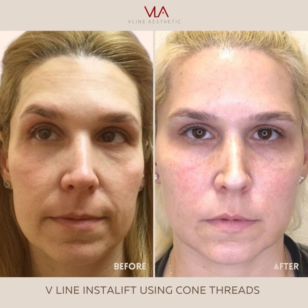 V Line Instalift using Cone threads before after