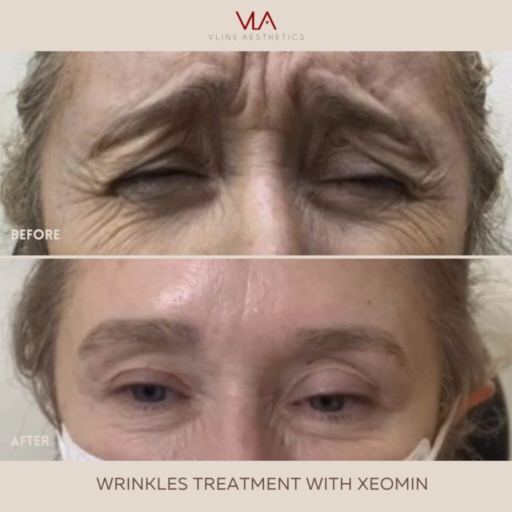 Skin Perfect brothers Wrinkle Treatments