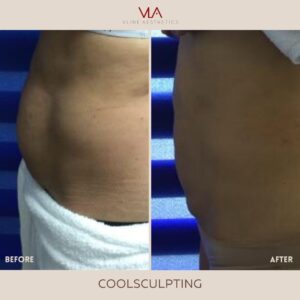 Skin perfect brothers cool sculpting