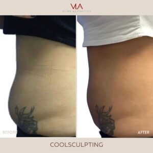 Skin perfect brothers coolsculpting