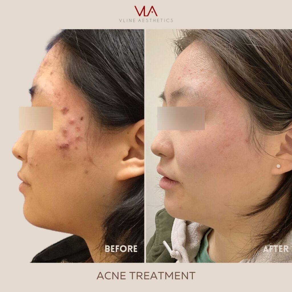 hormonal acne before and after