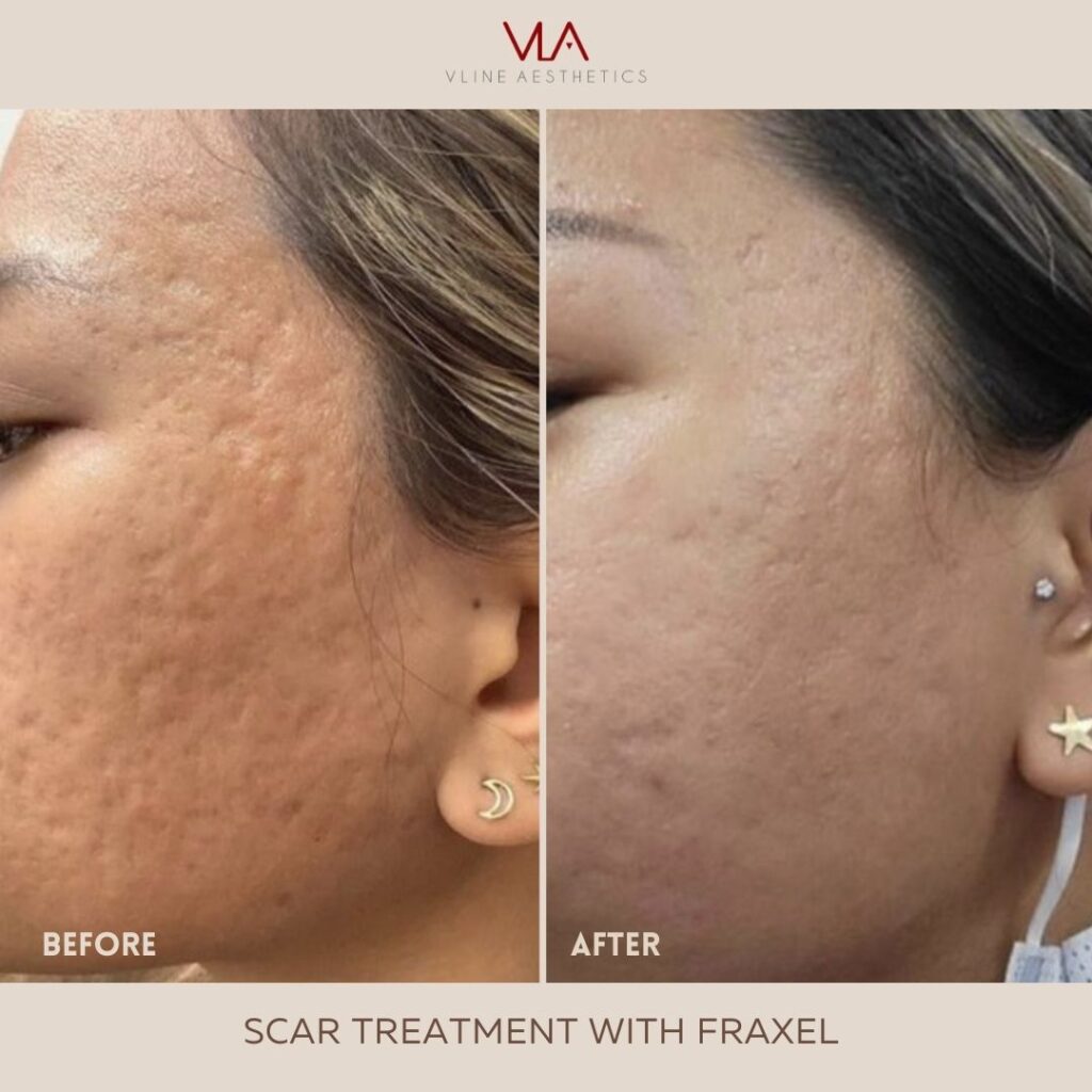 acne scar treatment with fraxel
