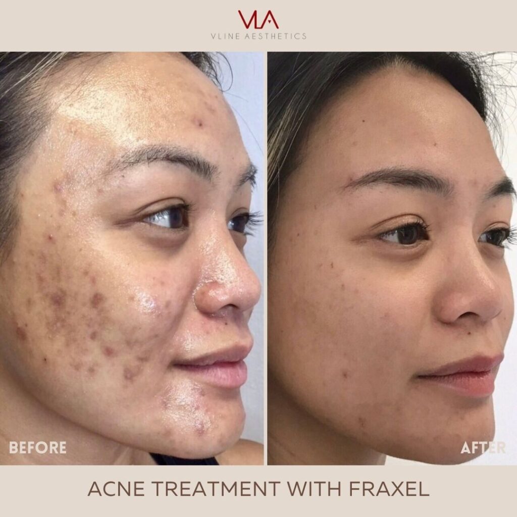 acne treatment with fraxel
