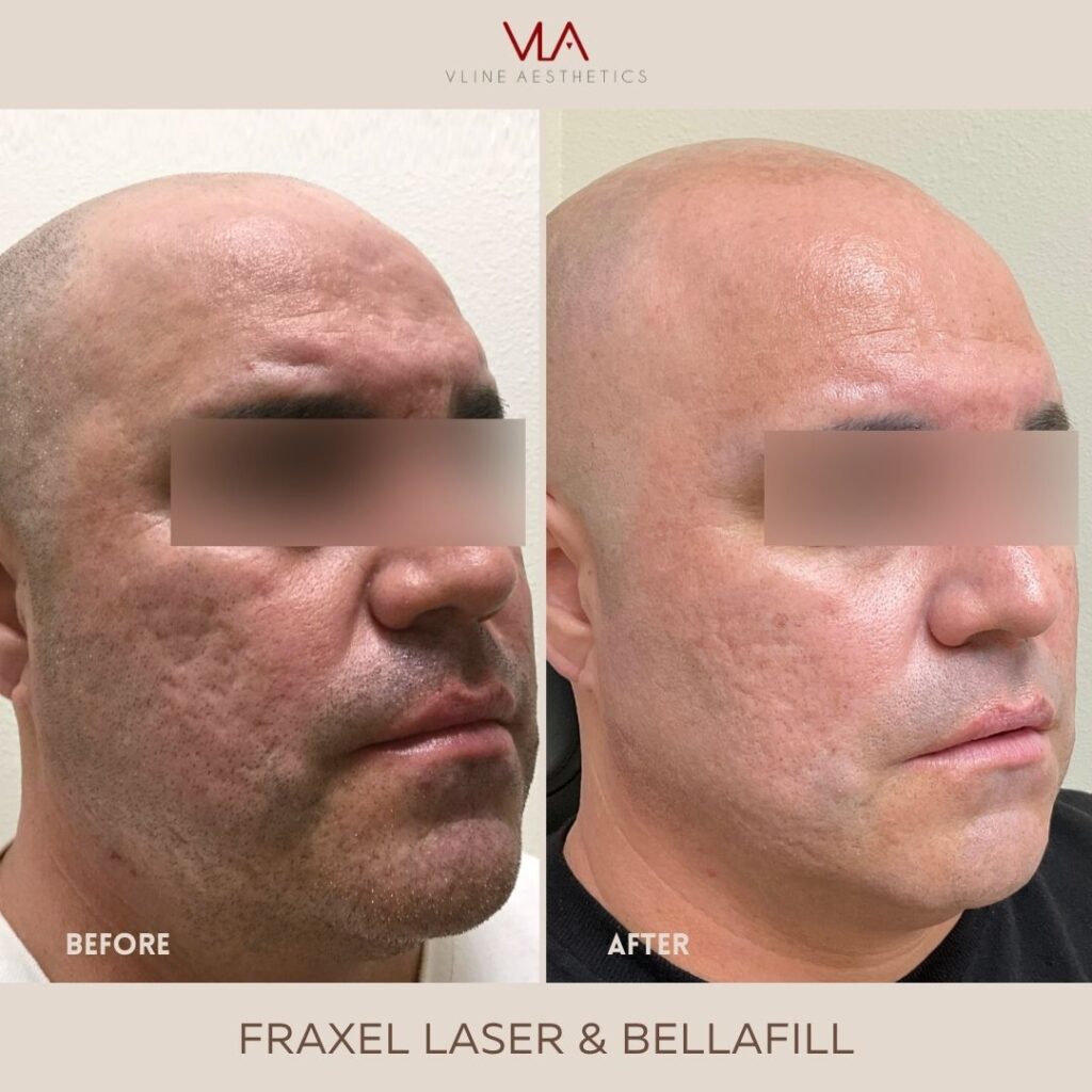 fraxel treatment male skin perfect brothers