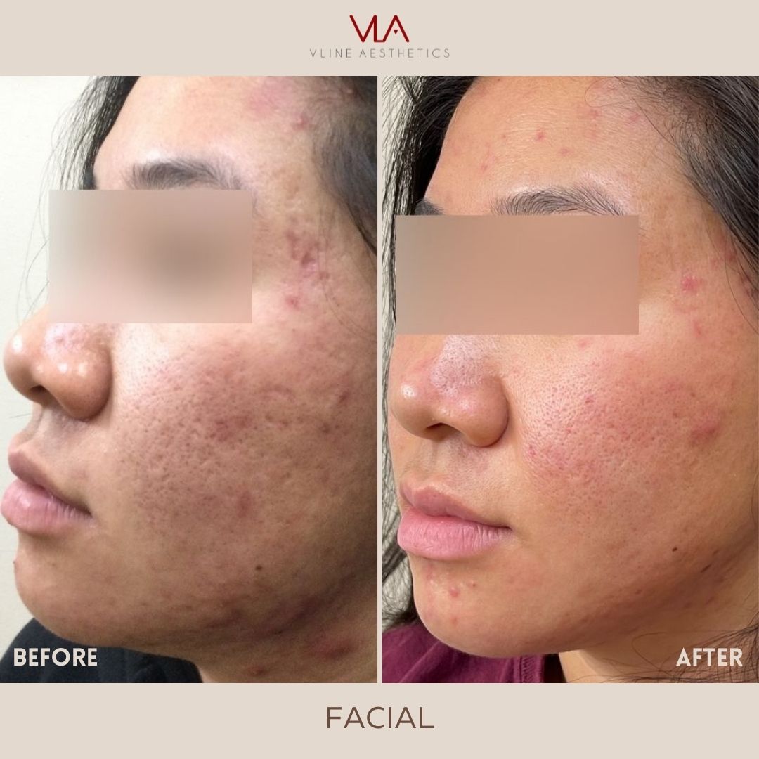 treating acne using facials