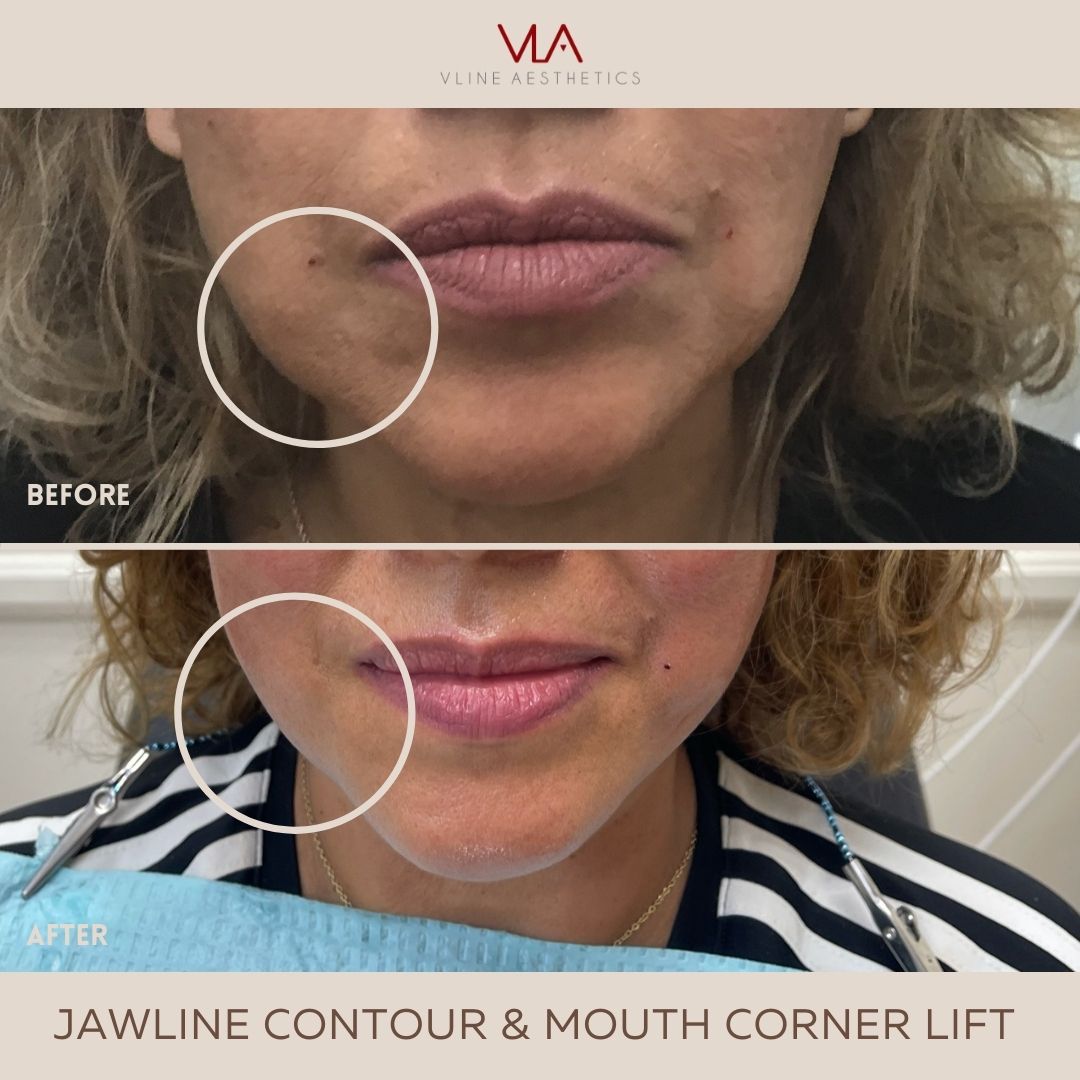 Mouth Corner Treatment Before and After