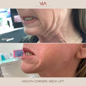 droopy mouth corner and neck lift