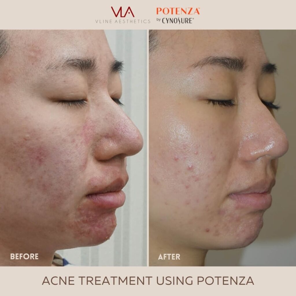 acne treatment with acne