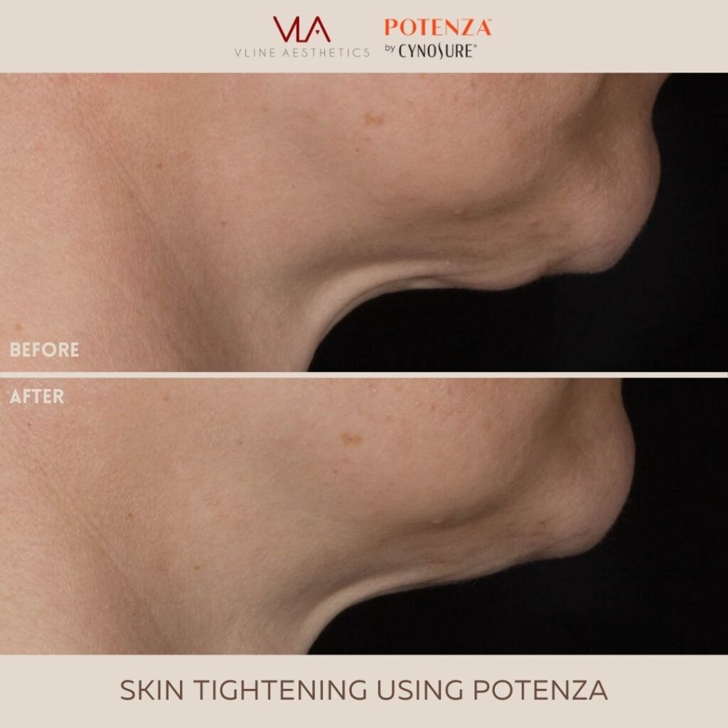 skin tightening with Potenza