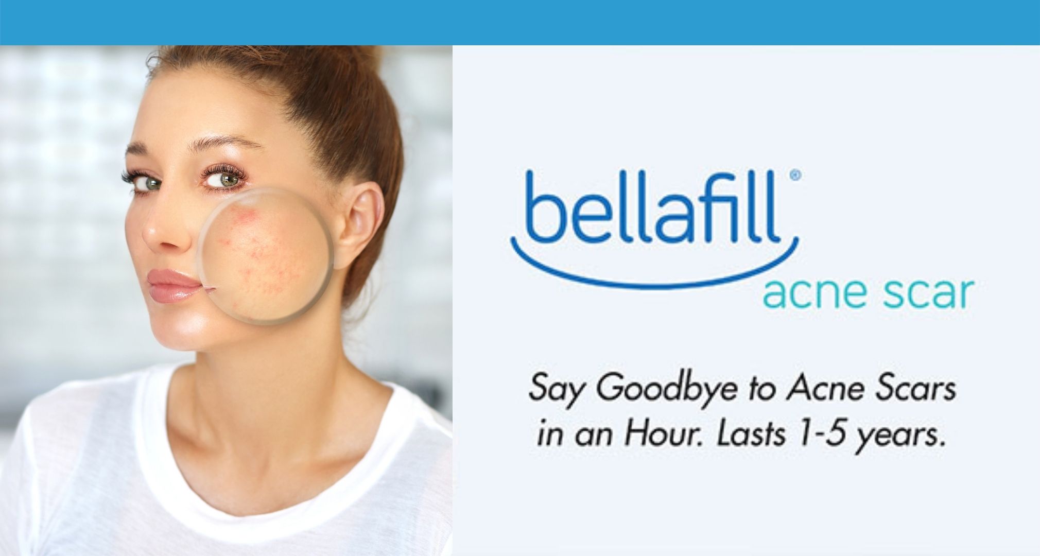 acne scars bellafill treatment
