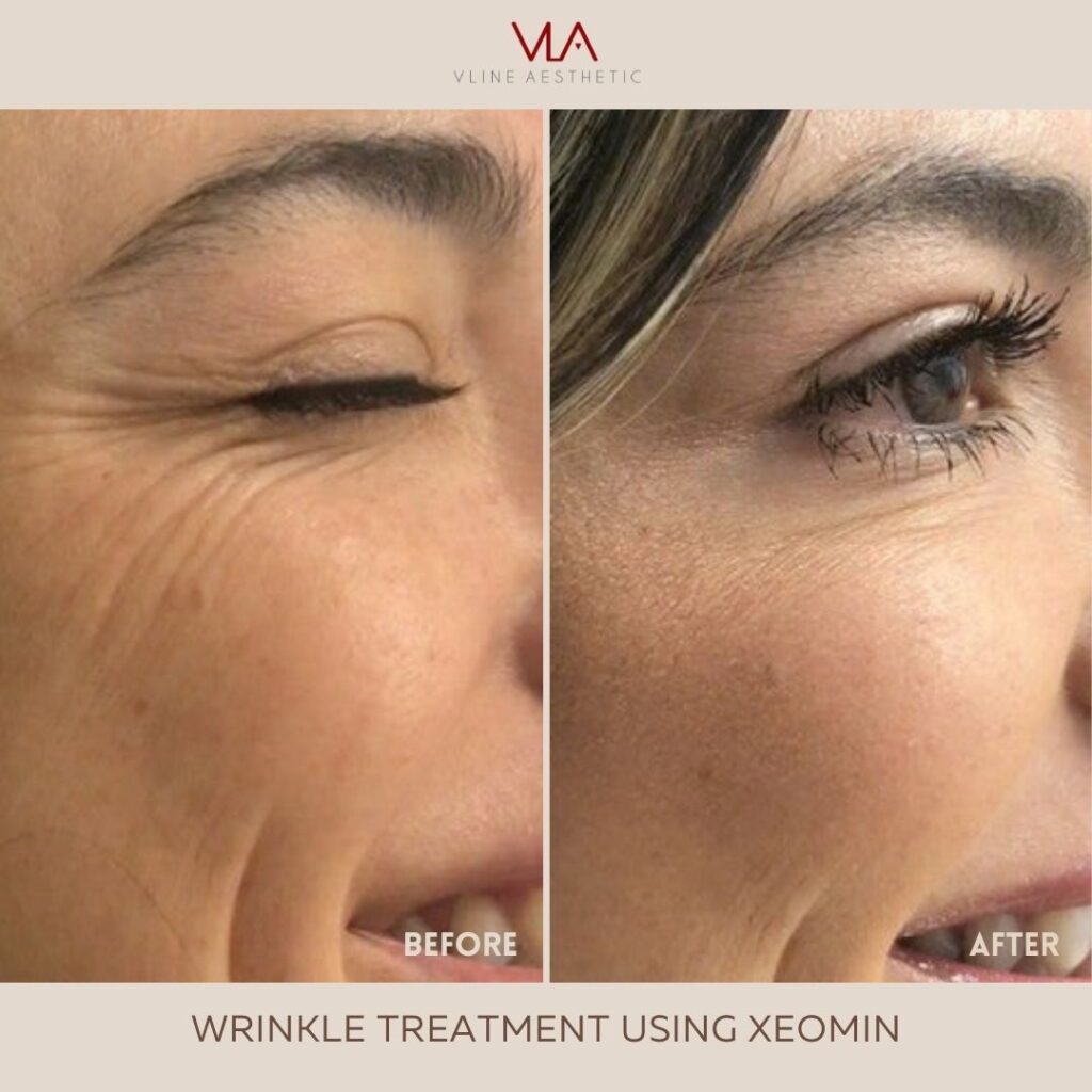 wrinkle treatment using yeoman