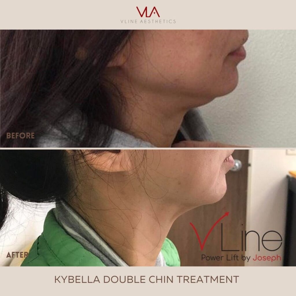 kybella treatment skin perfect brothers