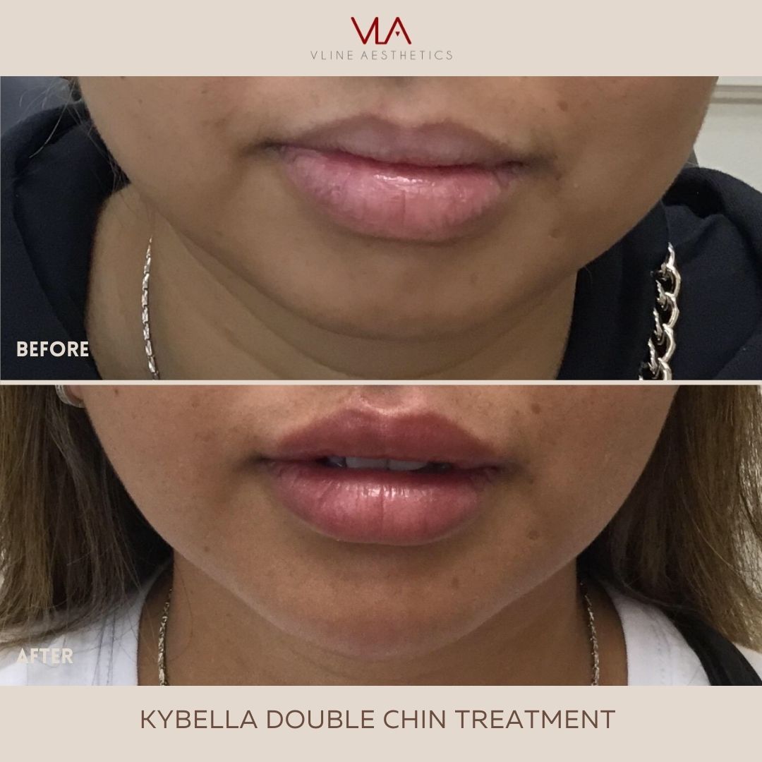 double chin with kybella