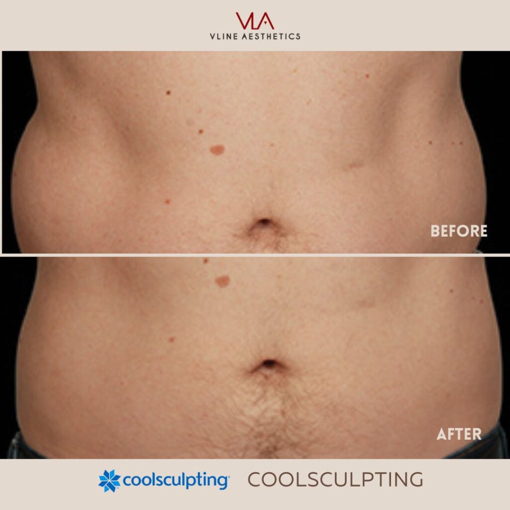 coolsculpting treatment skin perfect brothers