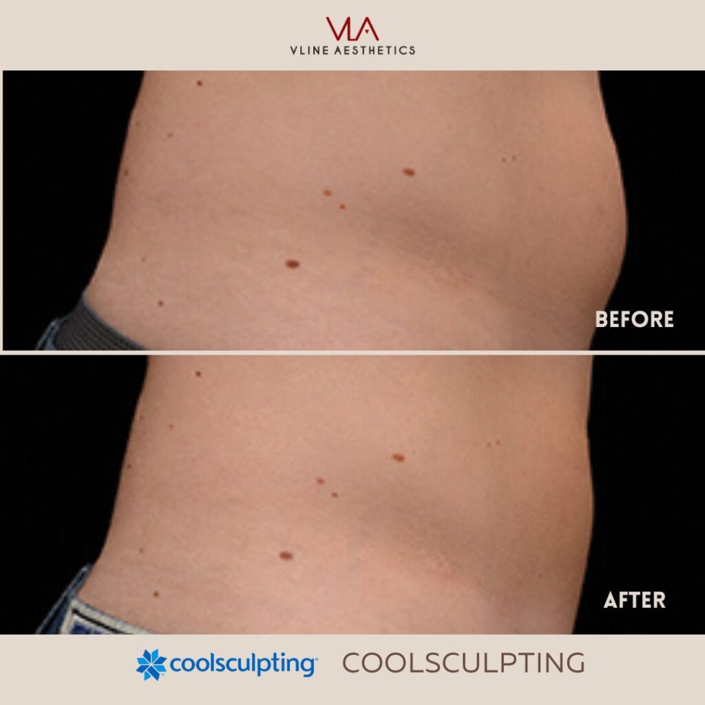coolsculpting treatment skin perfect brothers
