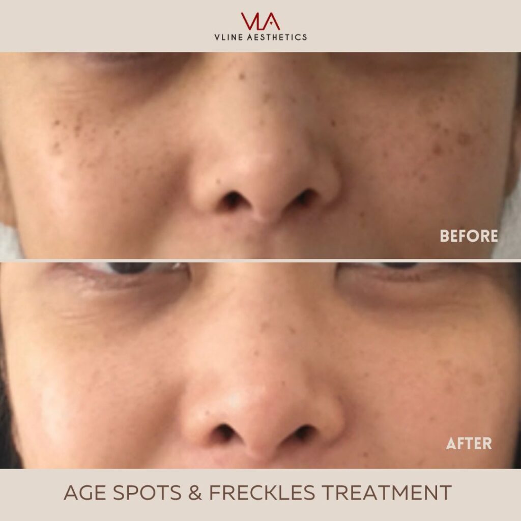 age spots with IPL treatment skin perfect brothers