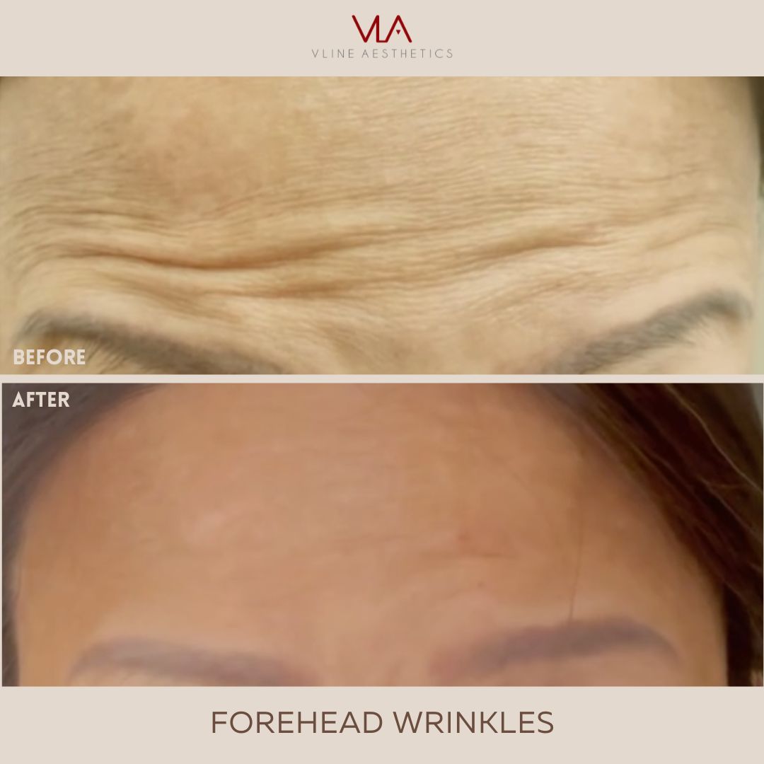 forehead wrinkles treatment skin perfect brothers