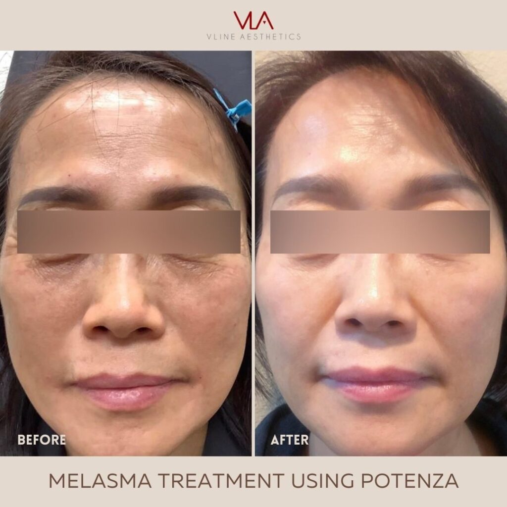 melasma treatment with potenza skin perfect brothers