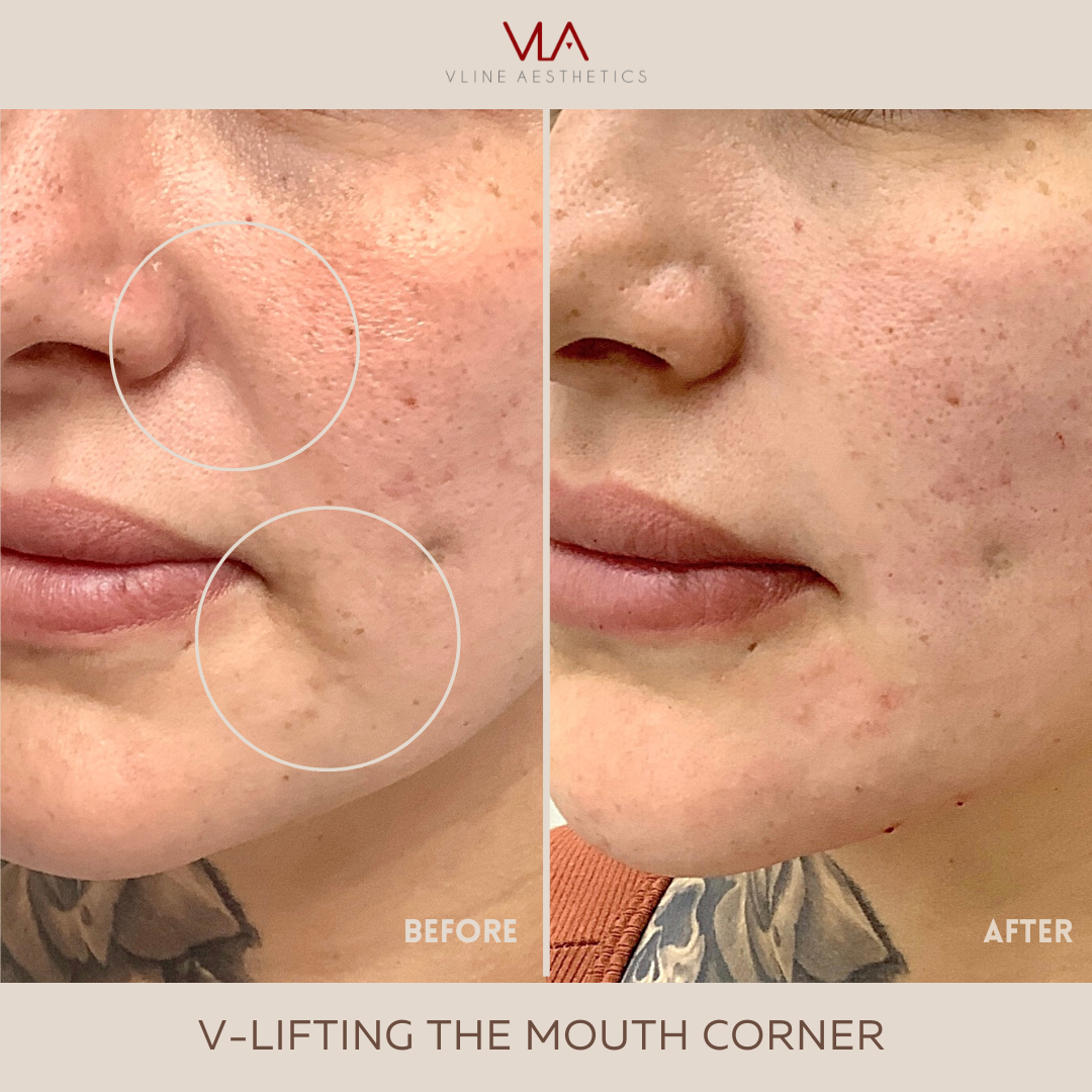 v lift for mouth corner skin perfect brothers