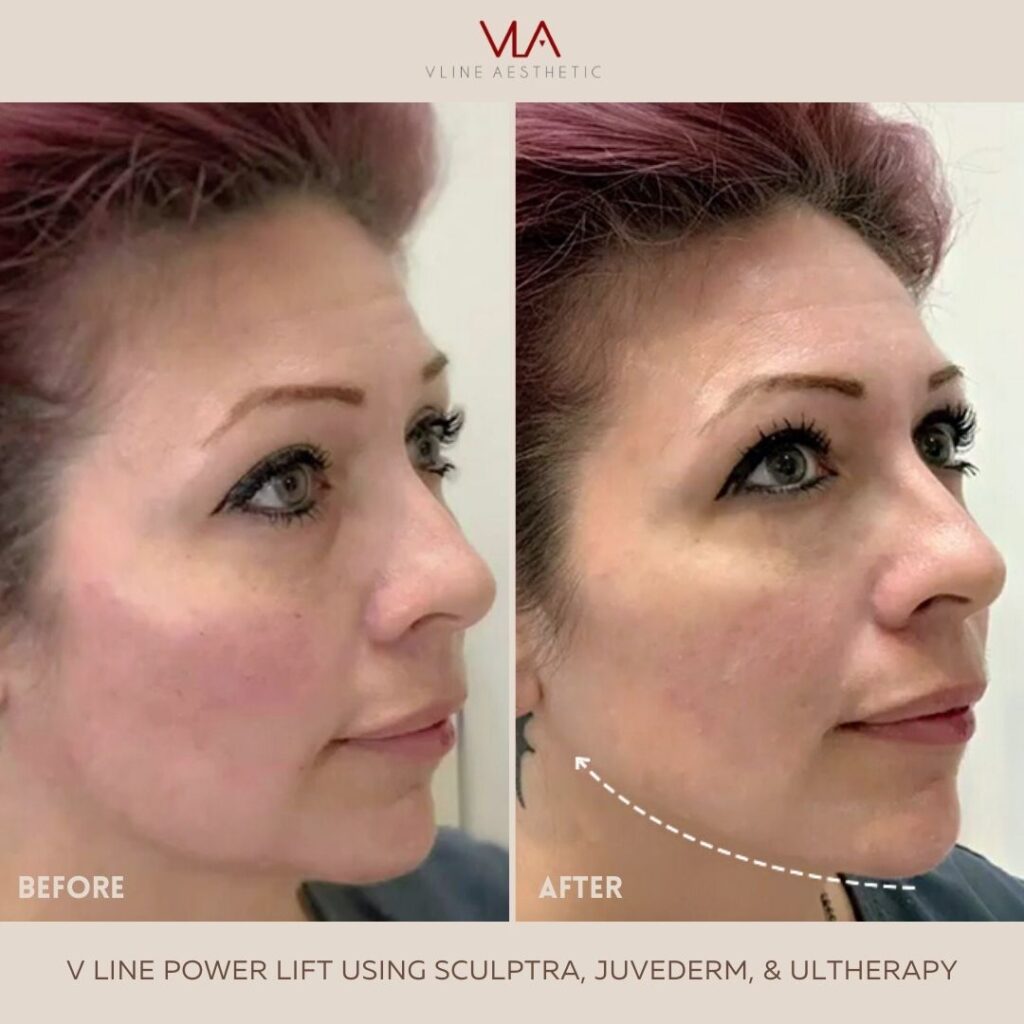 skin perfect brothers v line power lift using Ultherapy sculptra
