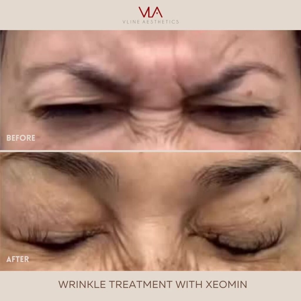 wrinkle treatment on furrows using xeomin skin perfect brothers