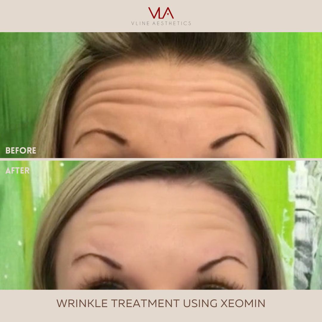 forehead wrinkle treatment using xeomin skin perfect brothers