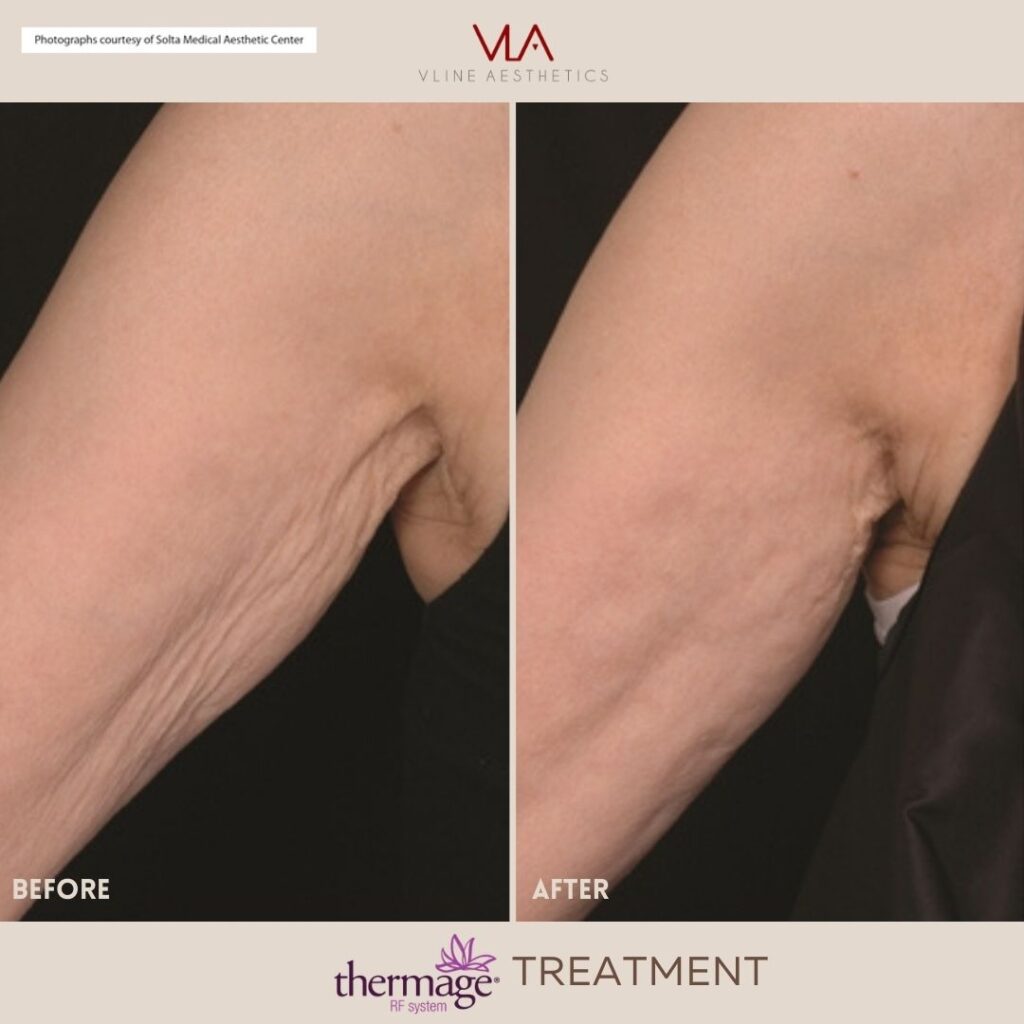 arm thermage treatment skin perfect brothers