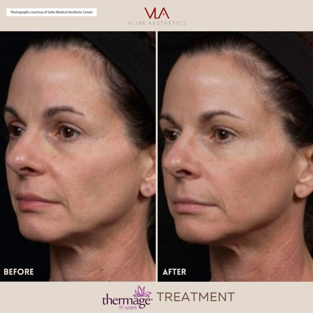 facial thermage treatment skin perfect brothers