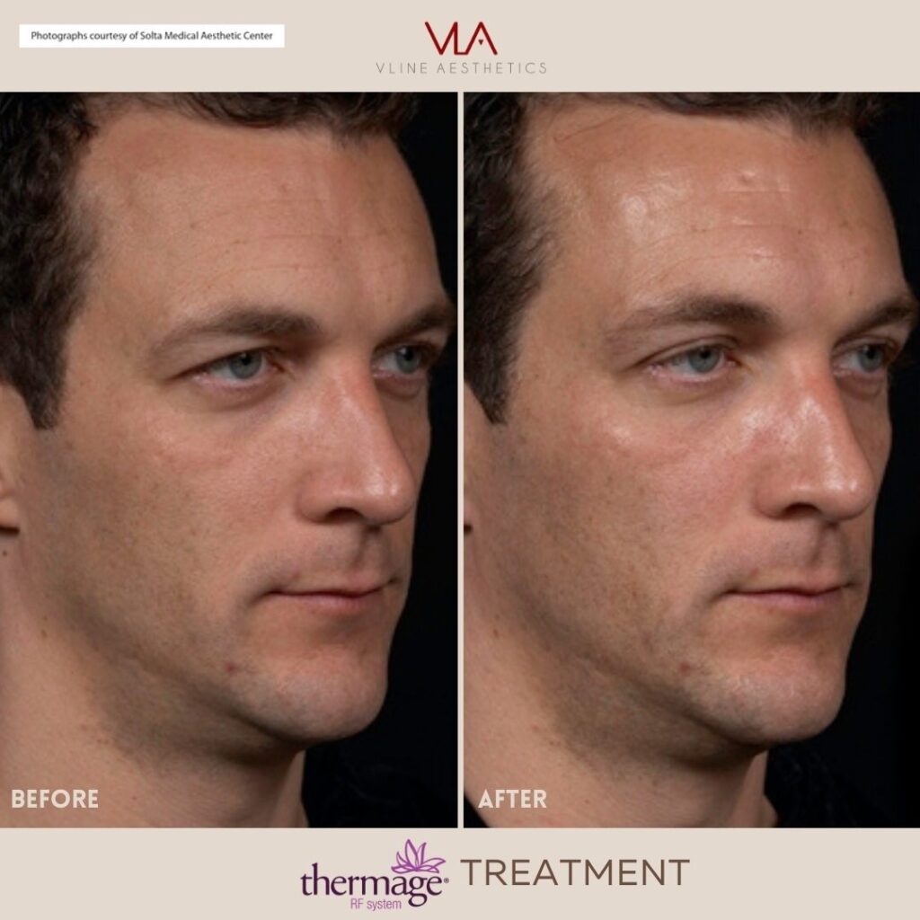 male face thermage treatment skin perfect brothers
