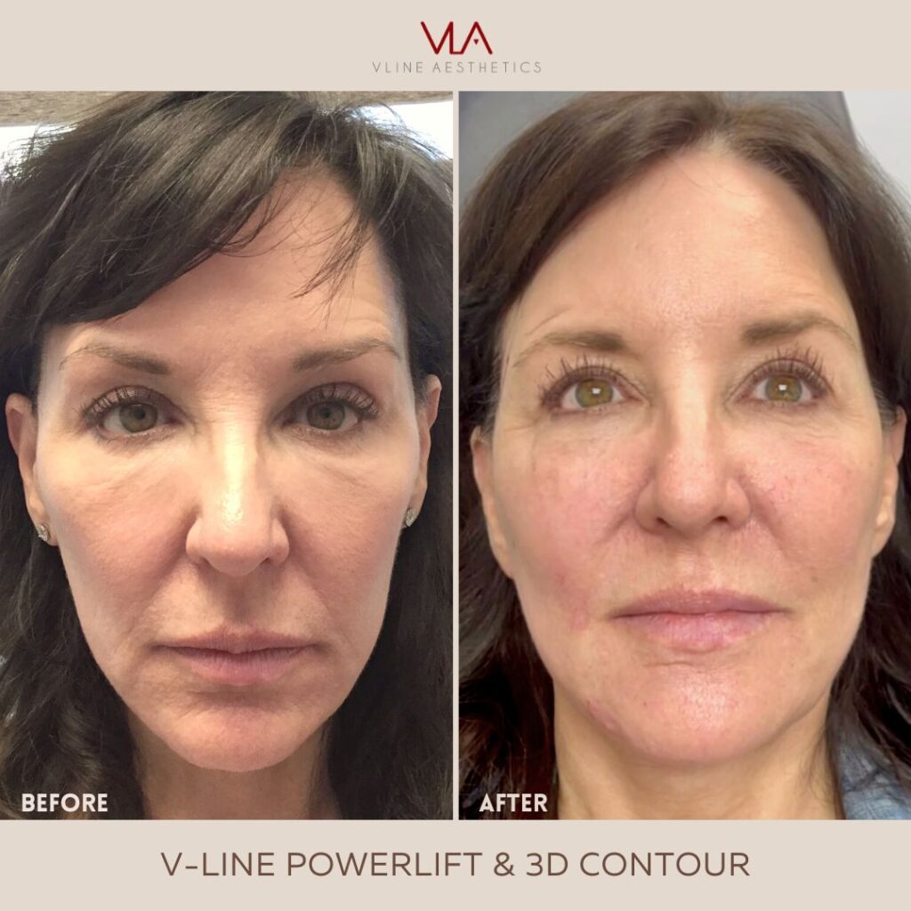 v line power lift and 3d contour skin perfect brothers