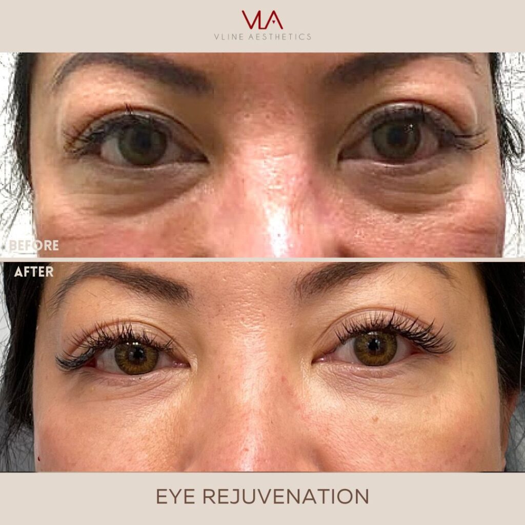 treating eyes eye rejuvenation