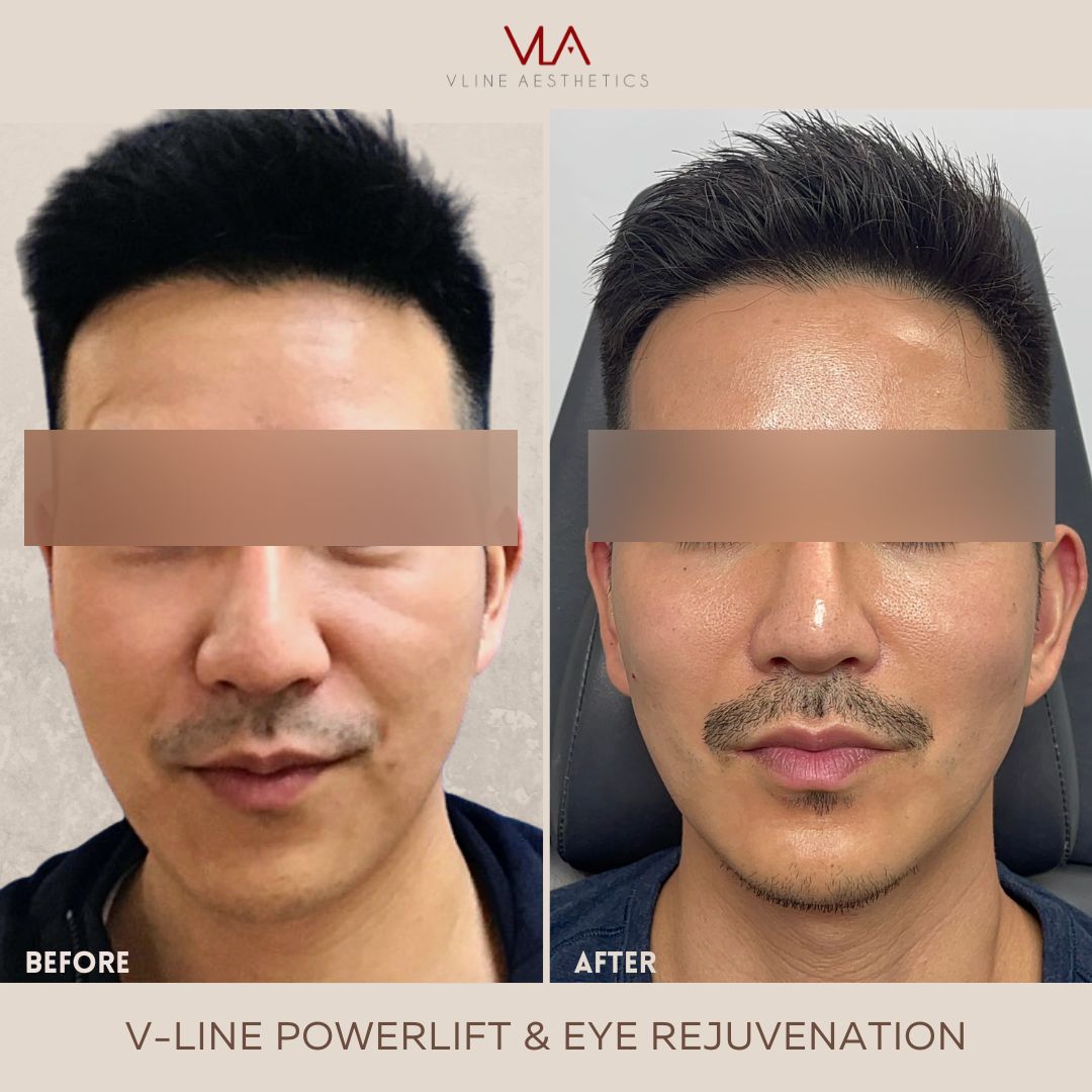 v line power lift eye rejuvenation